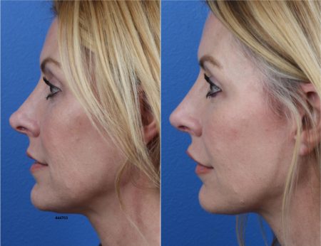 Rhinoplasty using NatraNose Technique by Dr. Miller