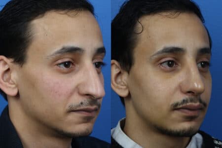 Rhinoplasty to Correct Nasal Bridge by Dr. Miller