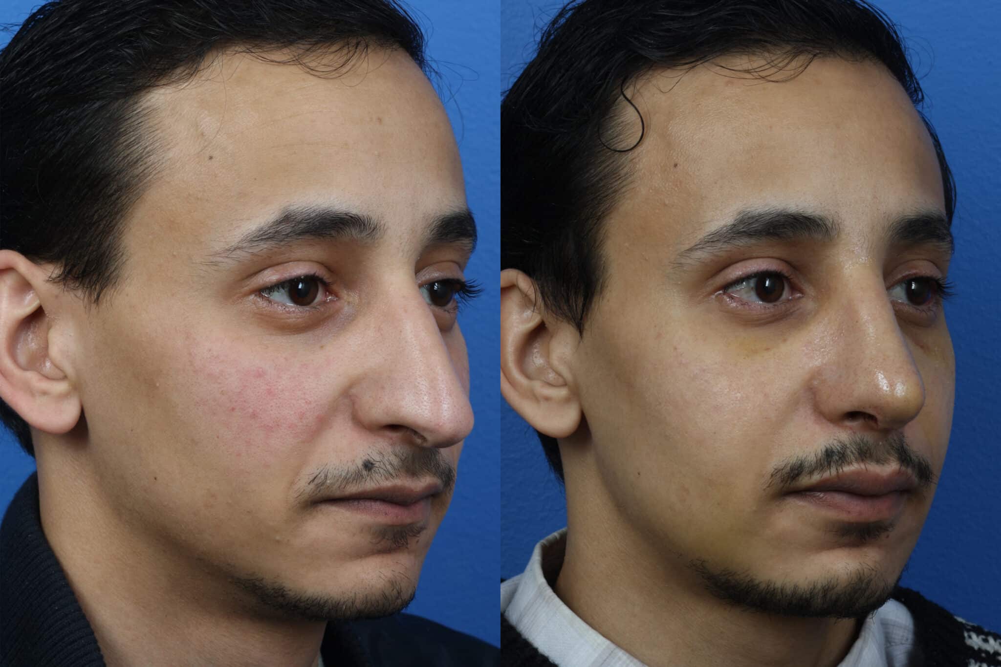 Rhinoplasty to straighten nasal bridge and shorten length of nose on a male patient. After surgery, nasal bridge has improved profile and nose is more proportionate to other facial features.