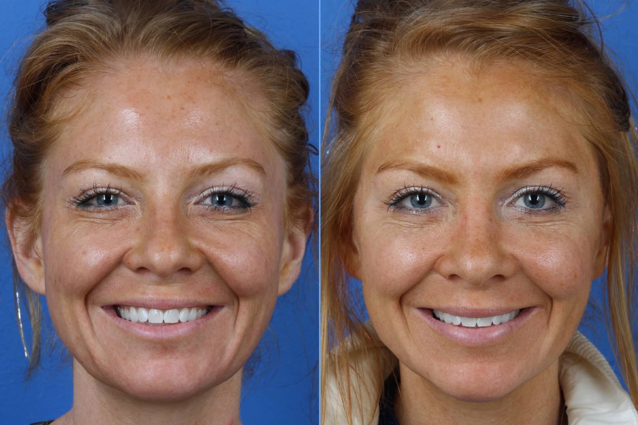 Micro Lift to reduce sagging skin and restore a more youthful appearance in a female patient. After minimally-invasive procedure, lines and creases are visibly reduced while face appears more youthful overall.