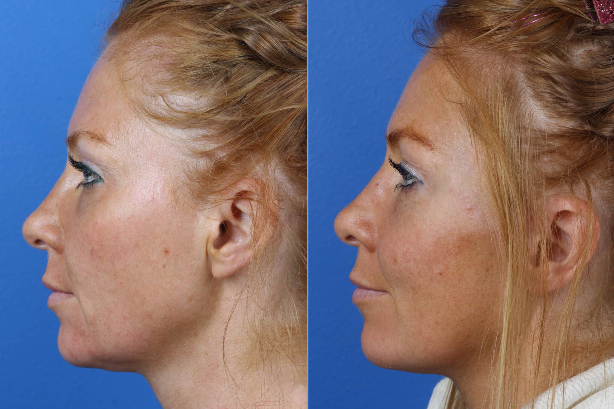 Micro Lift to correct skin laxity and other aging symptoms on a female patient. After procedure, facial profile looks lifted and more youthful.