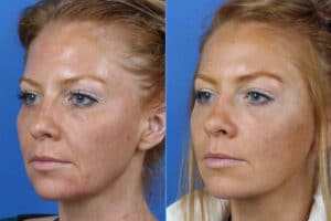 Micro Lift to address skin laxity and other early signs of aging in a female patient. Procedure firms and lifts skin while minimizing the appearance of fine lines and wrinkles.