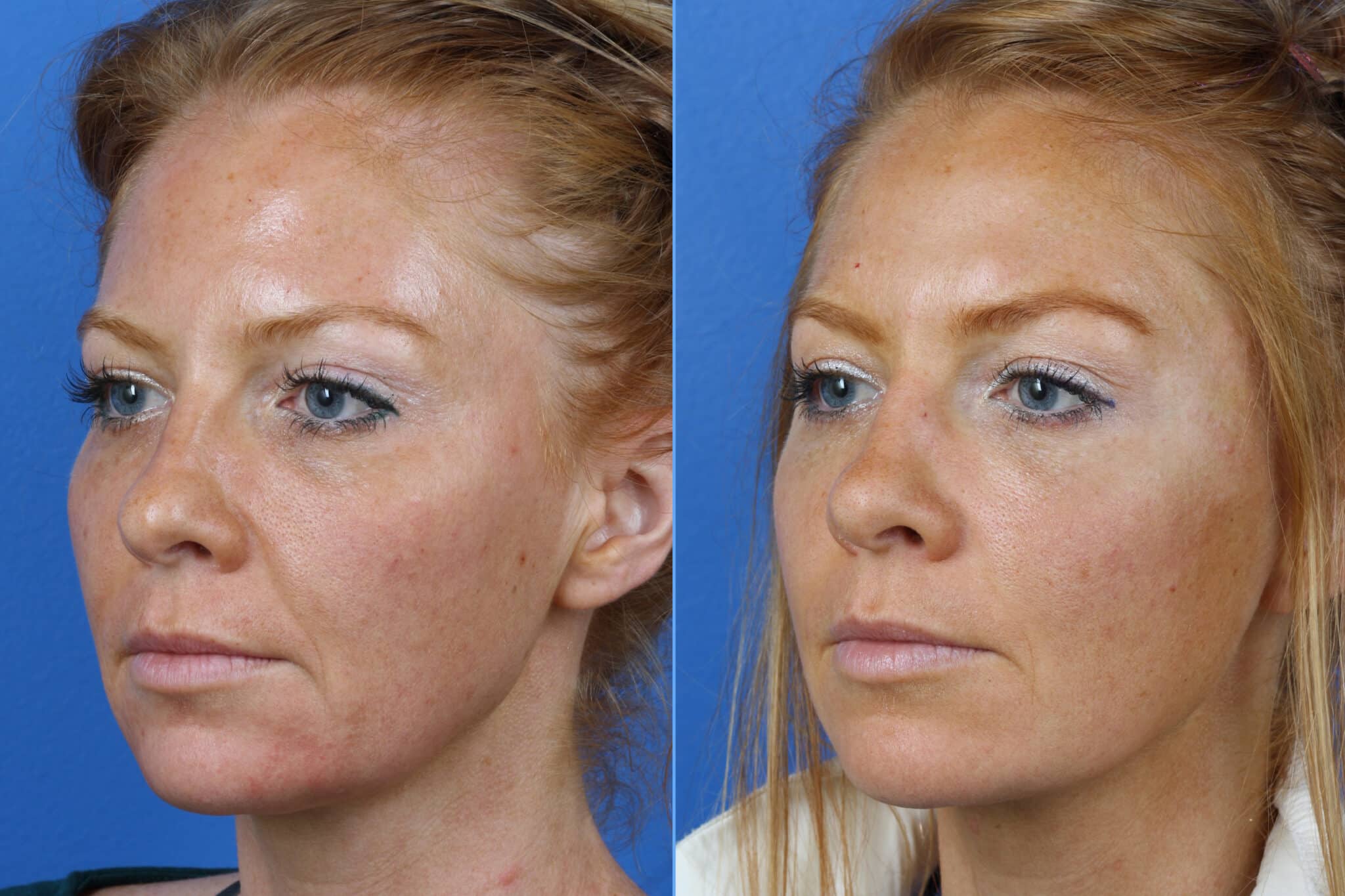 Micro Lift to address skin laxity and other early signs of aging in a female patient. Procedure firms and lifts skin while minimizing the appearance of fine lines and wrinkles.