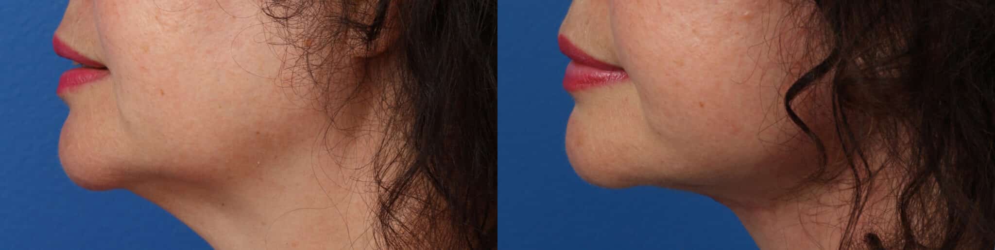 Facelift and neck lift to correct sagging skin and jowl formation in a female patient. Surgery improves definition along the jawline, neck, and under the chin.