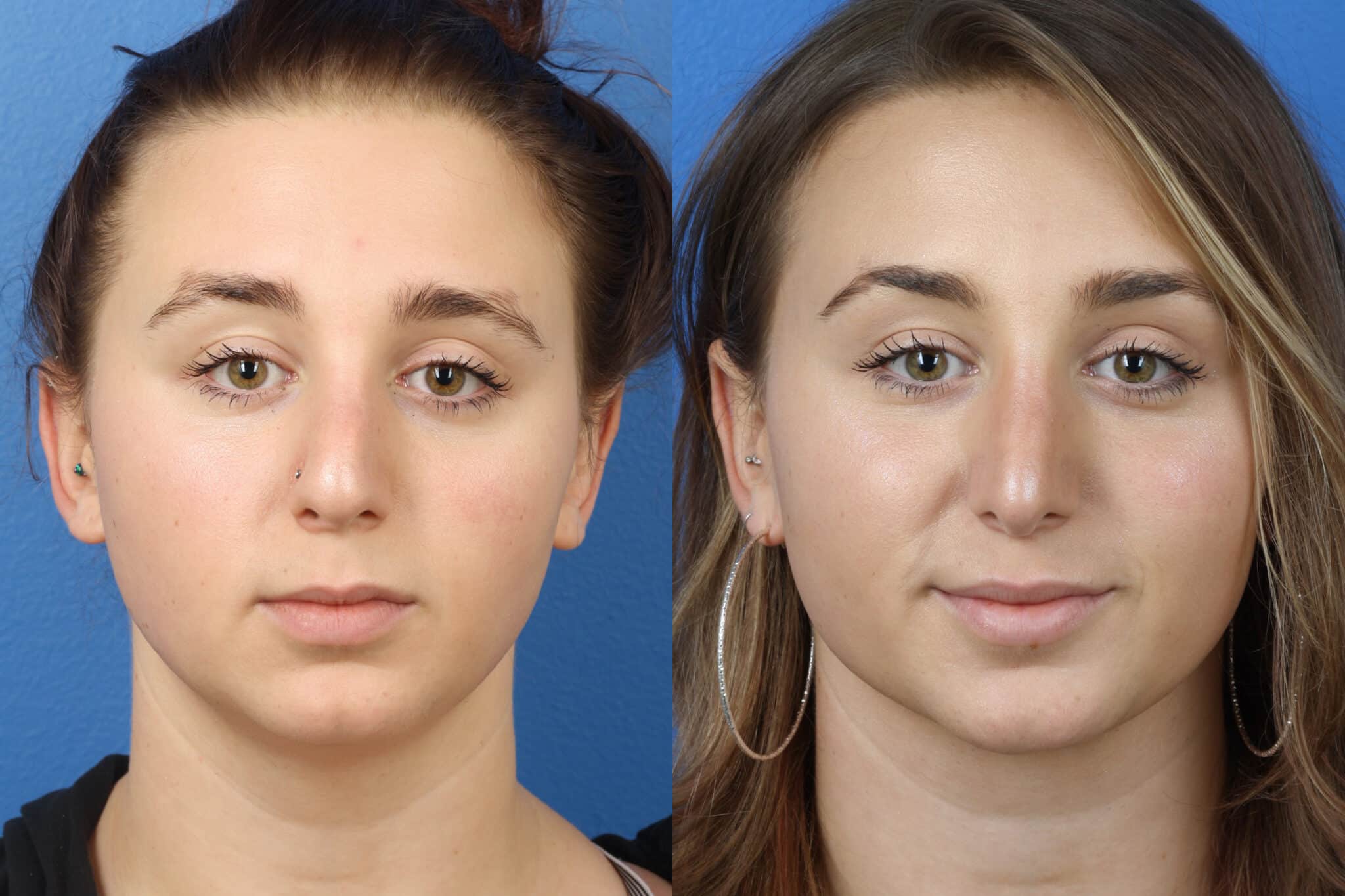 Rhinoplasty to remove hump from nasal bridge and improve nose shape of a female patient. After surgery, nose has a more aesthetically pleasing shape and is proportionate to the rest of the facial features.