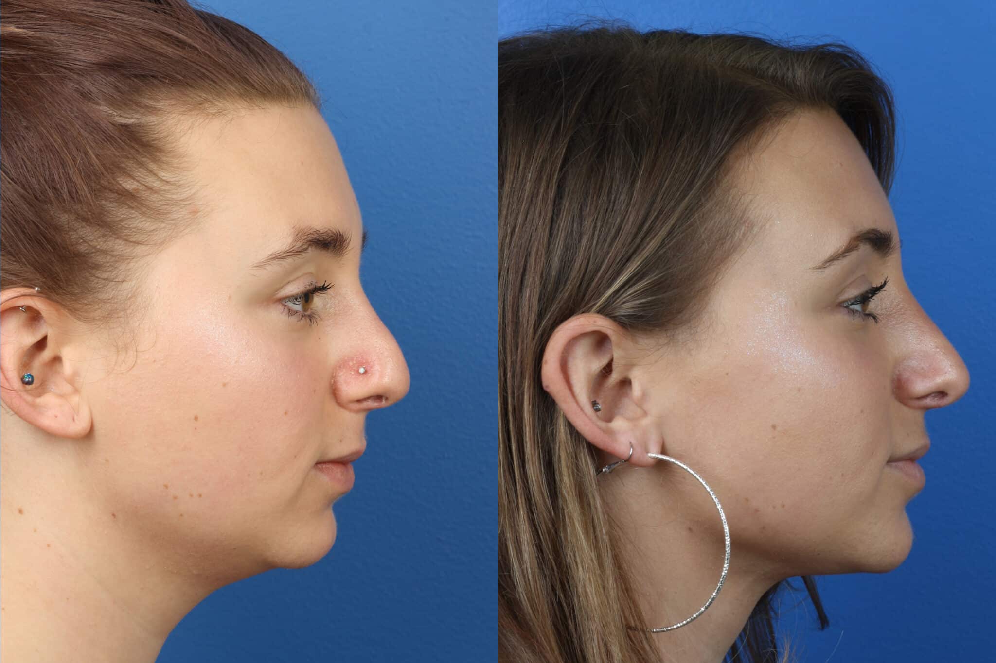 Rhinoplasty to straighten nasal bridge and enhance tip on a female patient. After surgery, hump is removed from nasal bridge and nose has a more attractive, proportionate shape and size.