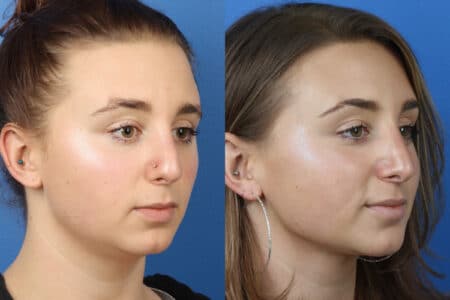 Rhinoplasty to Improve Nasal Bridge and Tip by Dr. Miller