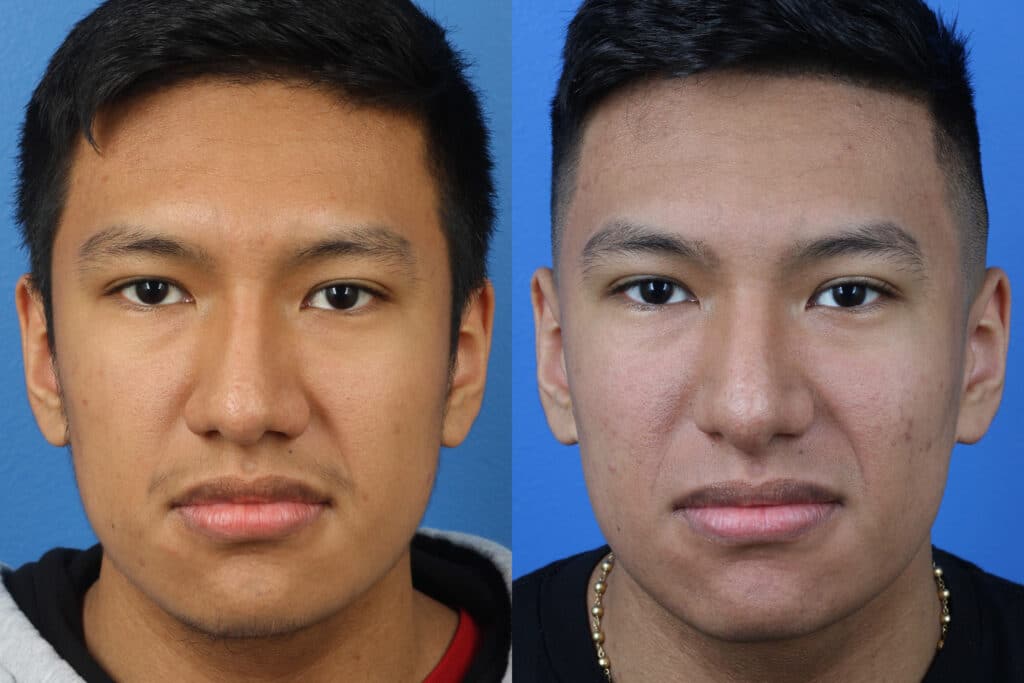 Rhinoplasty to straighten nasal bridge and improve nose shape of a male patient. After surgery, nose is straighter to balance other facial features.