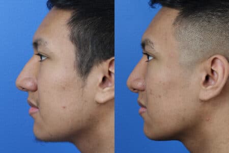 Rhinoplasty to Correct Nasal Bridge by Dr. Miller