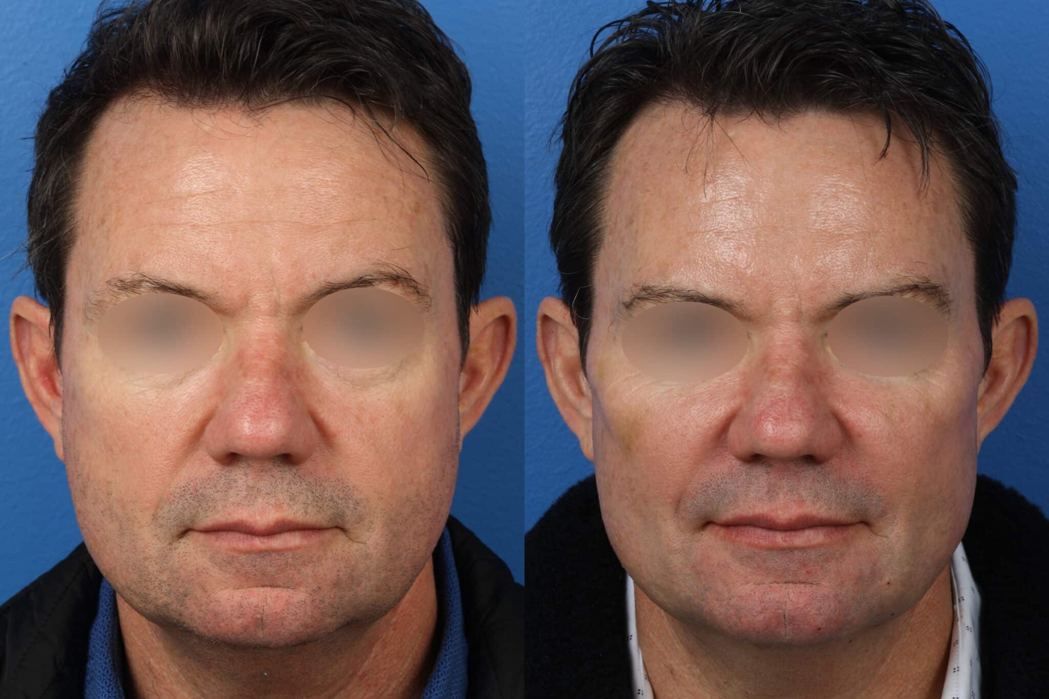 Brow lift to raise the brow position and reverse forehead drooping. After surgery, patient looks refreshed and more youthful in the upper face.