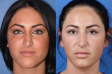 Rhinoplasty to Straighten Nasal Bridge by Dr. Miller