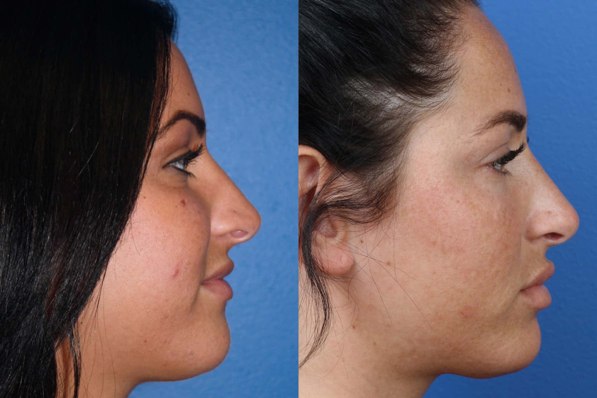 Rhinoplasty to improve nose shape and facial profile on a female patient. Surgery refines nose shape to balance the nose profile with other facial features.