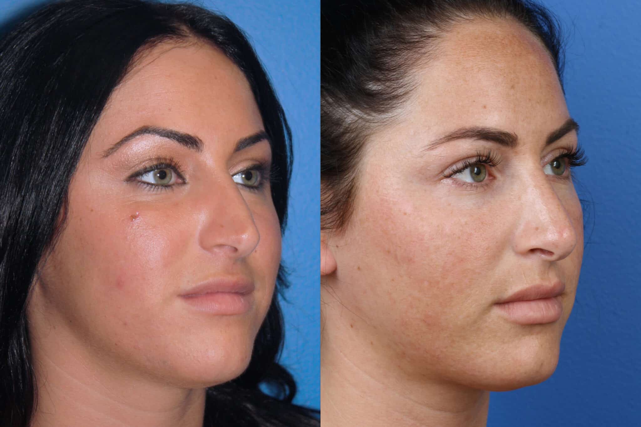 Rhinoplasty to improve nasal bridge and refine tip on a female patient. Surgery straightens nasal bridge and creates more attractive nasal tip.