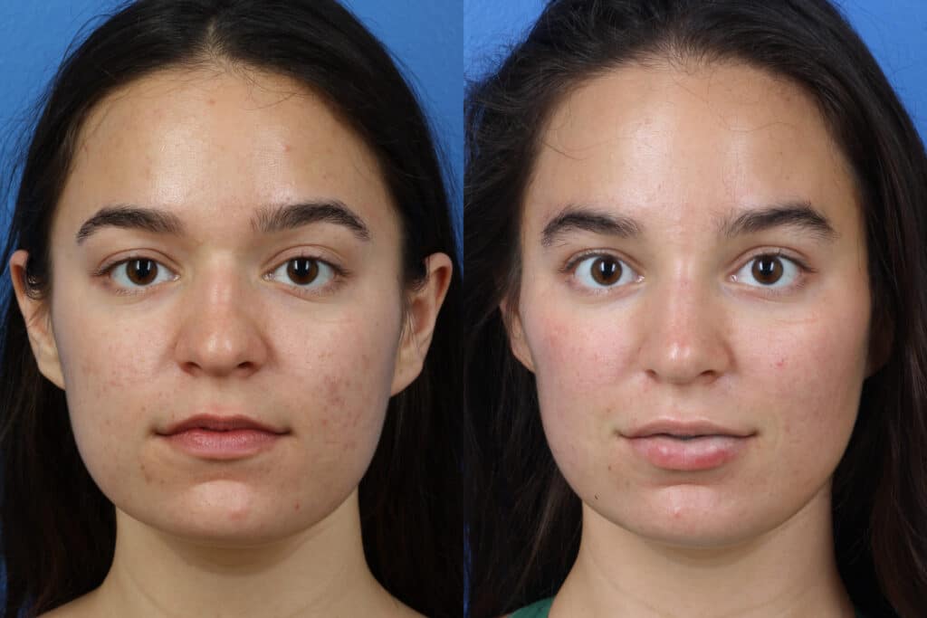 Rhinoplasty to improve shape and profile of nose on a female patient. After surgery, nose has more aesthetically pleasing shape and is proportionate to other facial features.