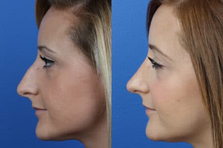 Rhinoplasty to Correct Nasal Bridge by Dr. Miller