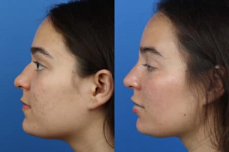 Rhinoplasty to Remove Hump from Nasal Bridge by Dr. Miller