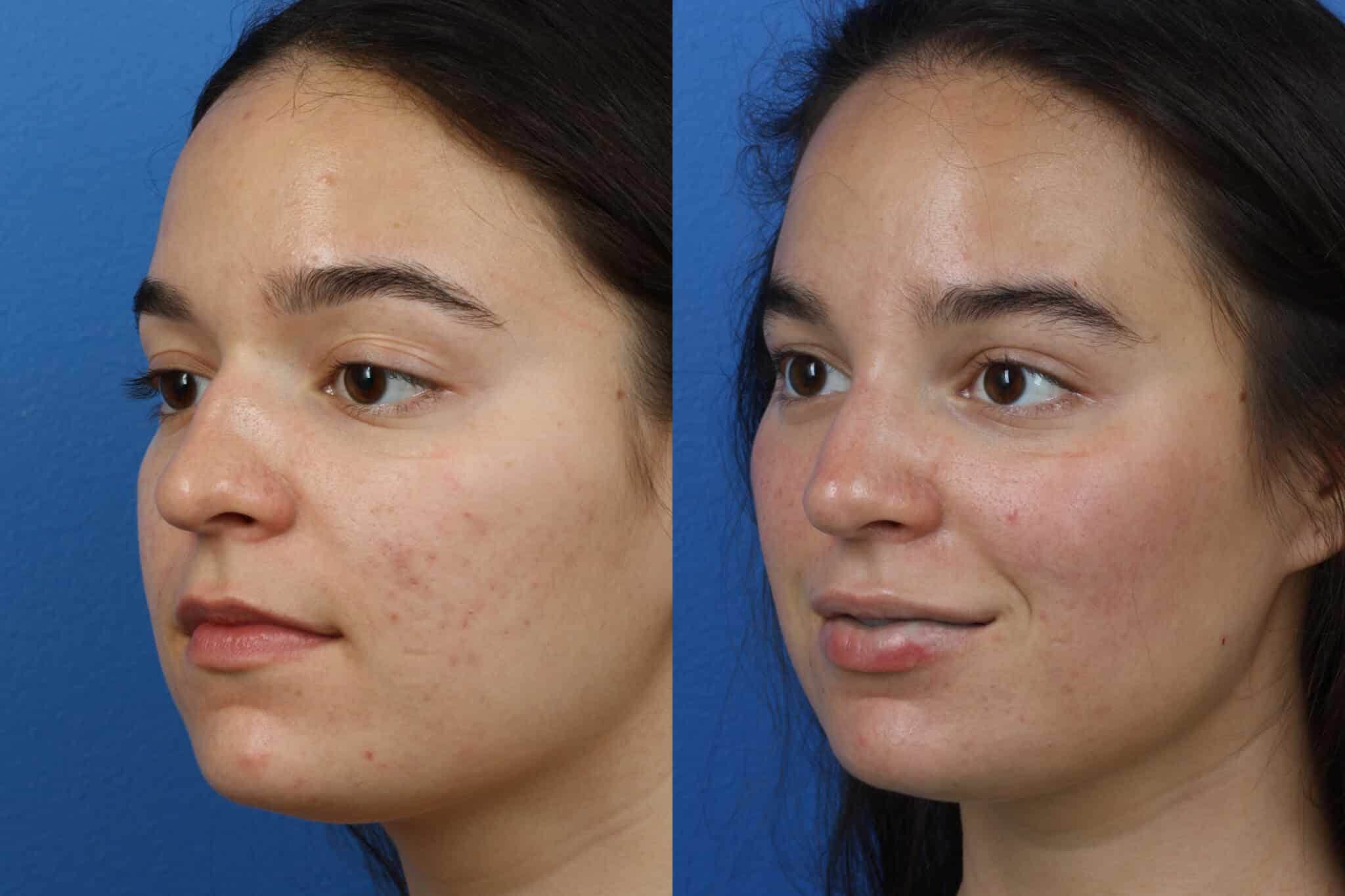 Rhinoplasty to remove dorsal hump and refine nose shape of a female patient. After surgery, nasal bridge is straighter and nose is more proportionate to other facial features.