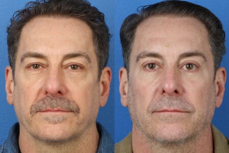 Upper and Lower Blepharoplasty to Rejuvenate Eyes by Dr. Miller