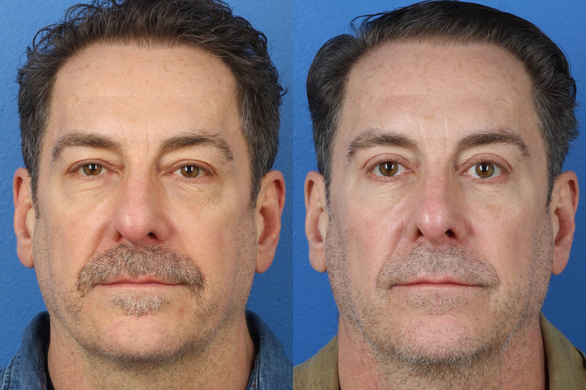Upper and lower blepharoplasty to open and rejuvenate the eyes of a male patient. After surgery, eyes look more awake and refreshed. Under eye bags are visibly reduced.