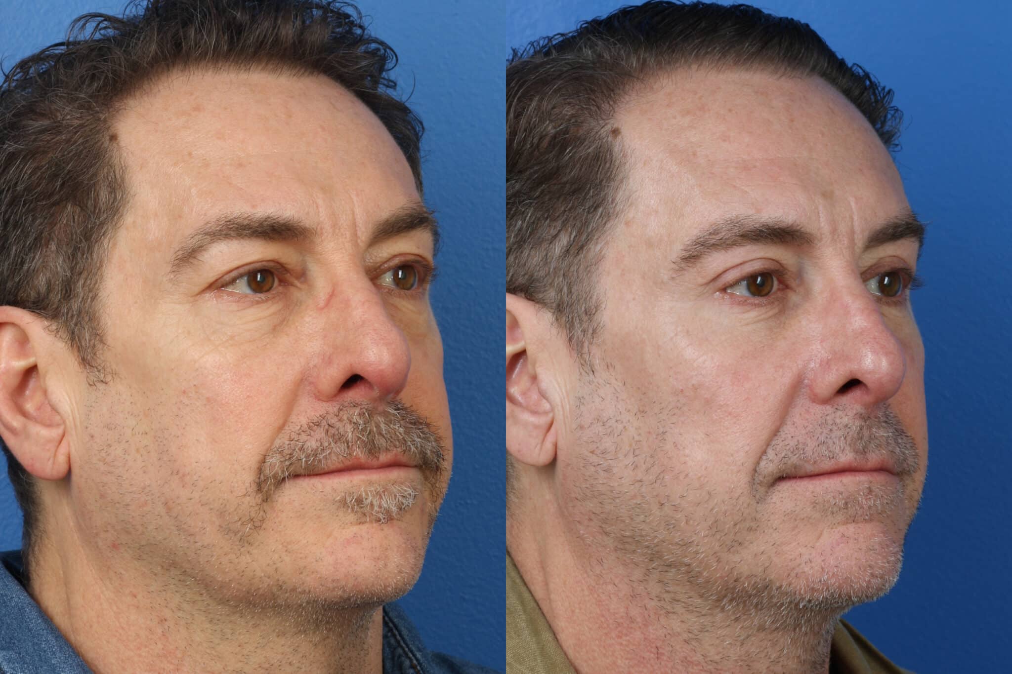 Upper and lower blepharoplasty to rejuvenate the eyes and reduce bags under the eyes of a male patient. After surgery, eyes are more open and refreshed, while under-eye bags are visibly reduced.
