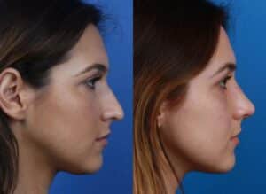 before and after of a rhinoplasty in new york