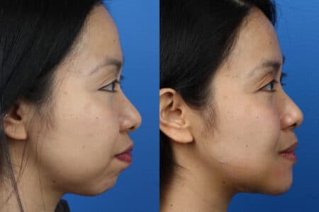 Chin Implant to Augment Chin by Dr. Miller