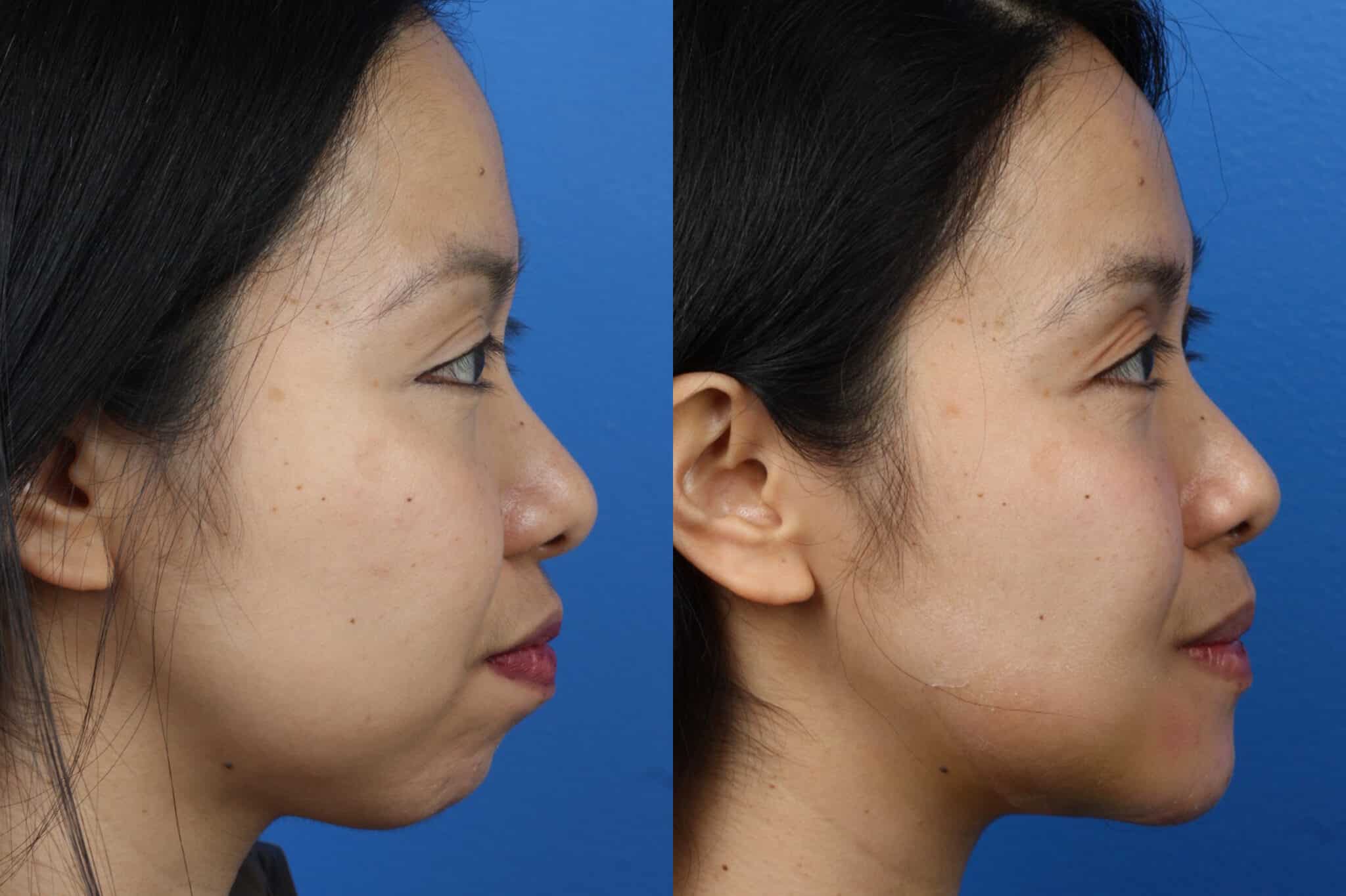 Chin implant to augment the chin and define the jawline of a female patient by Dr. Miller. Surgery creates stronger chin to improve the patient's profile.