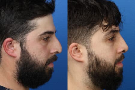 Rhinoplasty to correct nasal bridge and improve facial profile by Dr. Miller