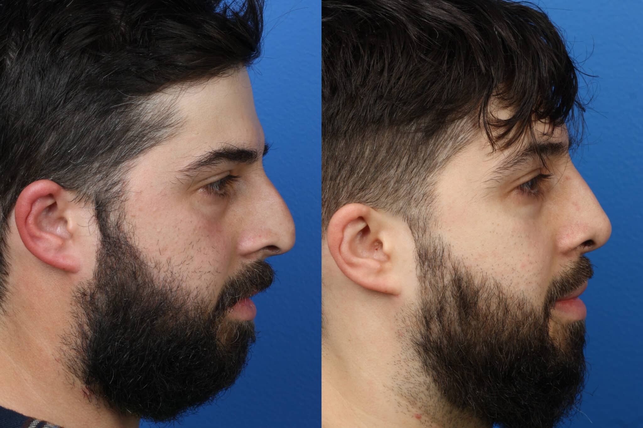 Rhinoplasty to correct nasal bridge and improve facial profile of a male patient by Dr. Miller. Surgery straightens bridge and corrects the drooping tip.