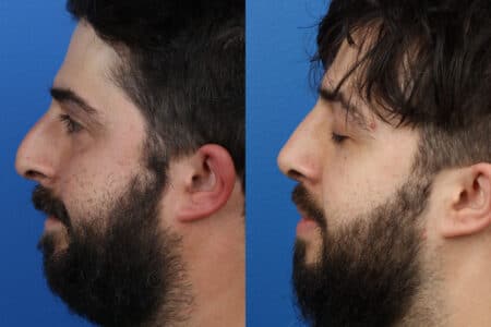 Rhinoplasty to remove a bump from the nasal bridge and enhance the facial profile by Dr. Miller.