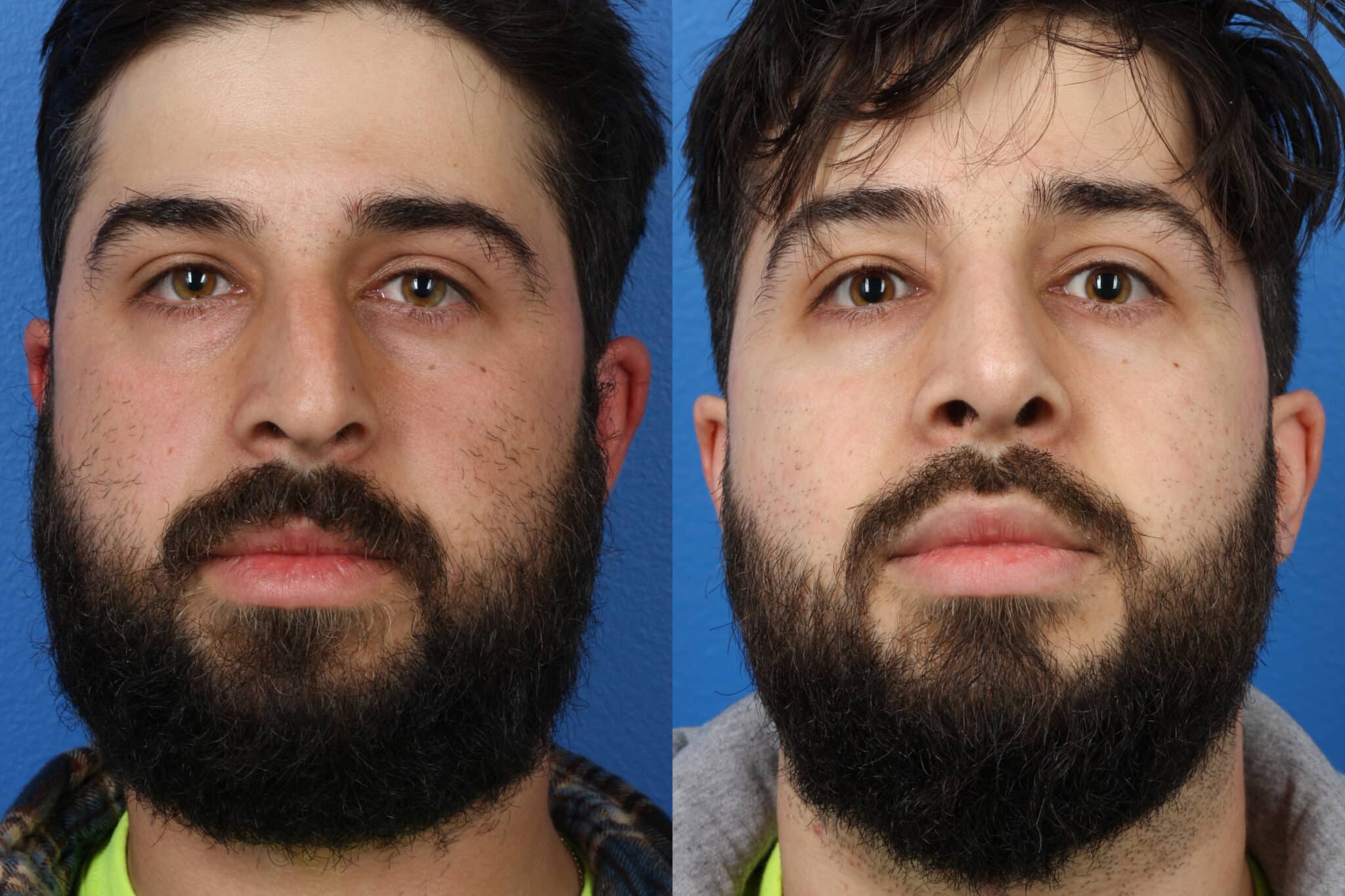 Rhinoplasty to improve the nose shape and refine the tip of a male patient by Dr. Miller. Surgery creates a more proportionate facial contour by refining bridge and tip.