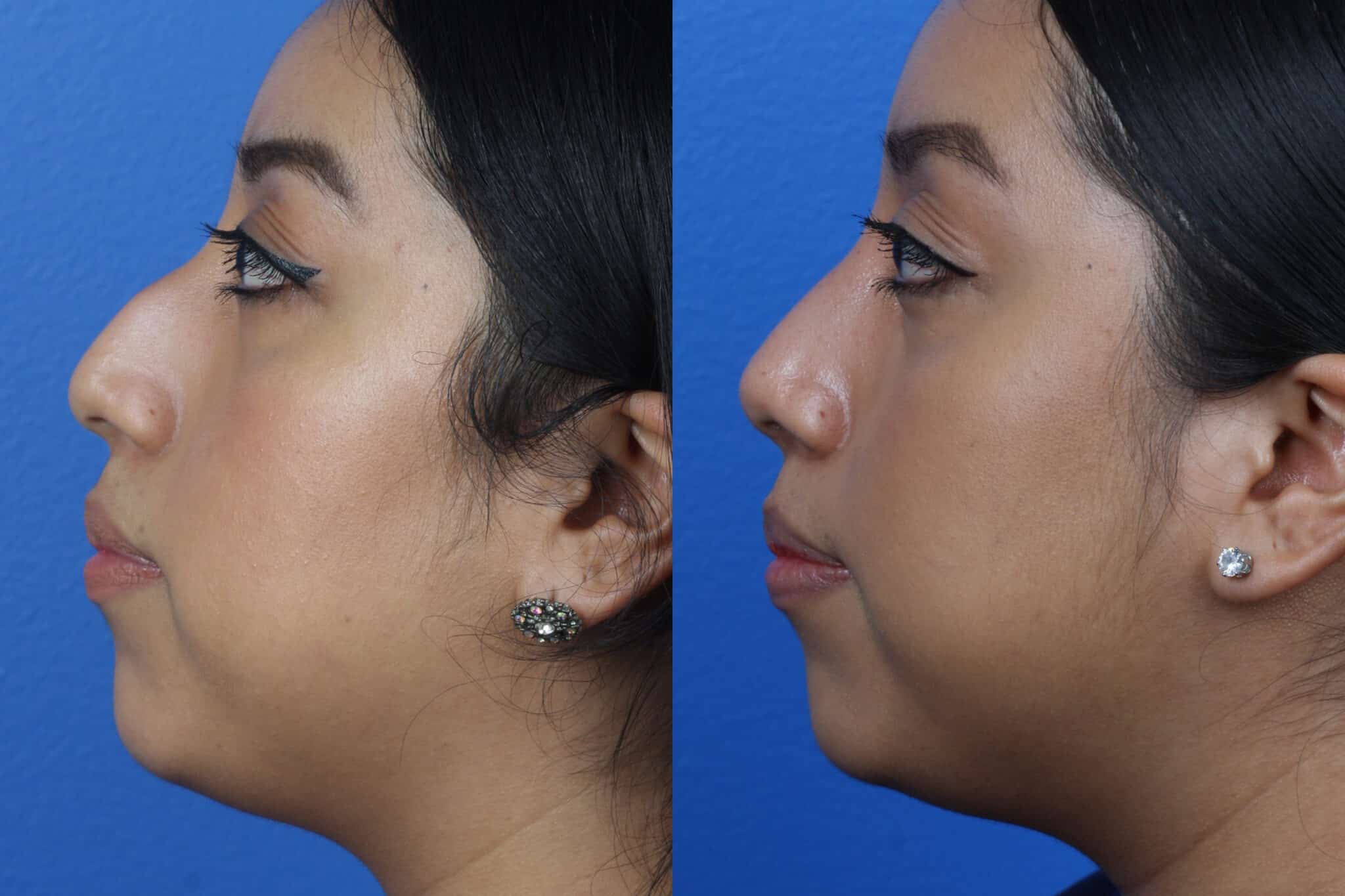 Rhinoplasty to remove dorsal hump and straighten nasal bridge on a female patient by Dr. Miller. After surgery, nasal bridge is straighter and tip is slightly rotated to improve the facial profile.