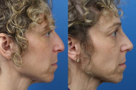 Rhinoplasty to Correct Nasal Bridge and Tip by Dr. Miller