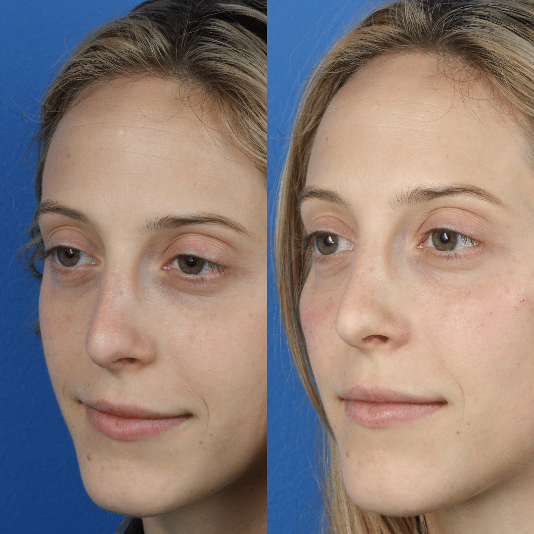 liquid facelift by Dr. Philip Miller in New York