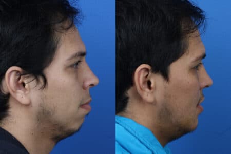 Chin Implant to Augment the Chin of a Male Patient by Dr. Miller