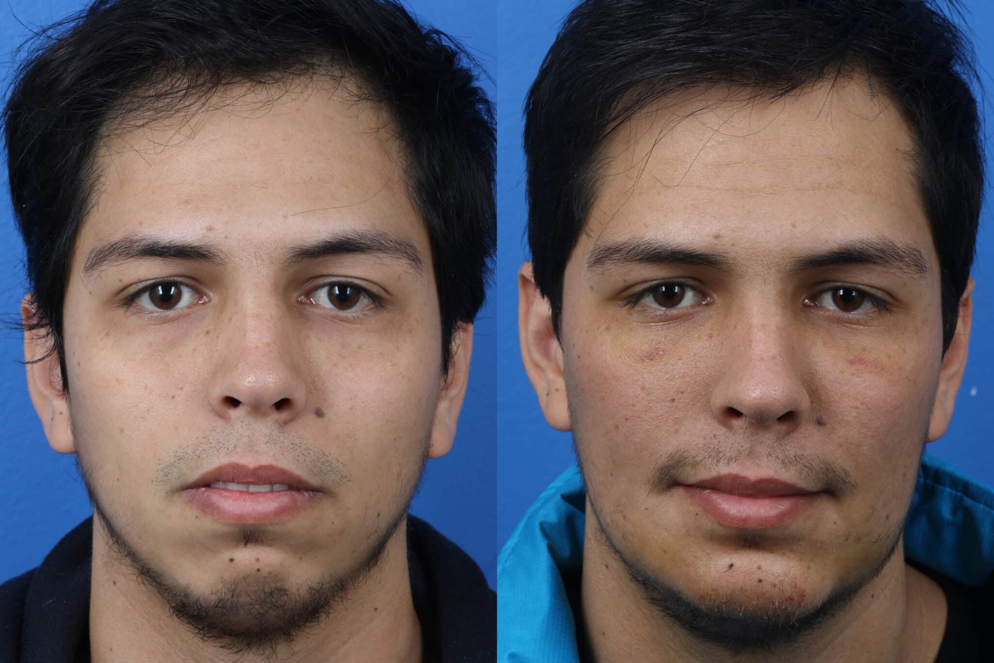 Chin implant to augment the chin of a male patient by Dr. Miller. Surgery creates a stronger chin and jawline.