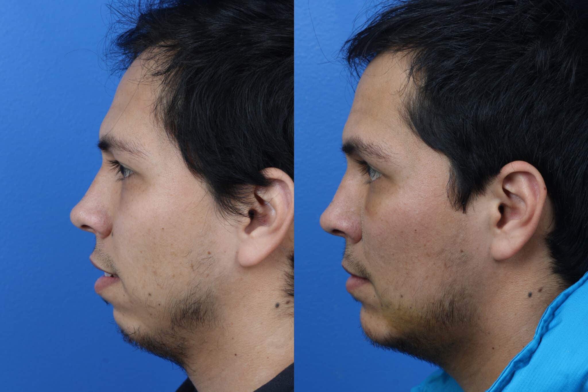Chin implant to augment the chin of a male patient by Dr. Miller. After surgery, patient's profile shows stronger chin and more proportionate contour.