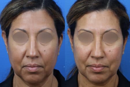 Filler to Augment the Cheeks of a Female Patient by Dr. Miller