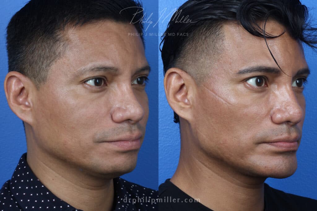 Split-screen image showing a man in two three-quarter profile portraits: left-facing on the left and right-facing on the right, against a blue background.