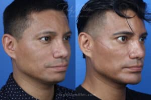 Necktite submental lipo chin implant Right Oblique Miller