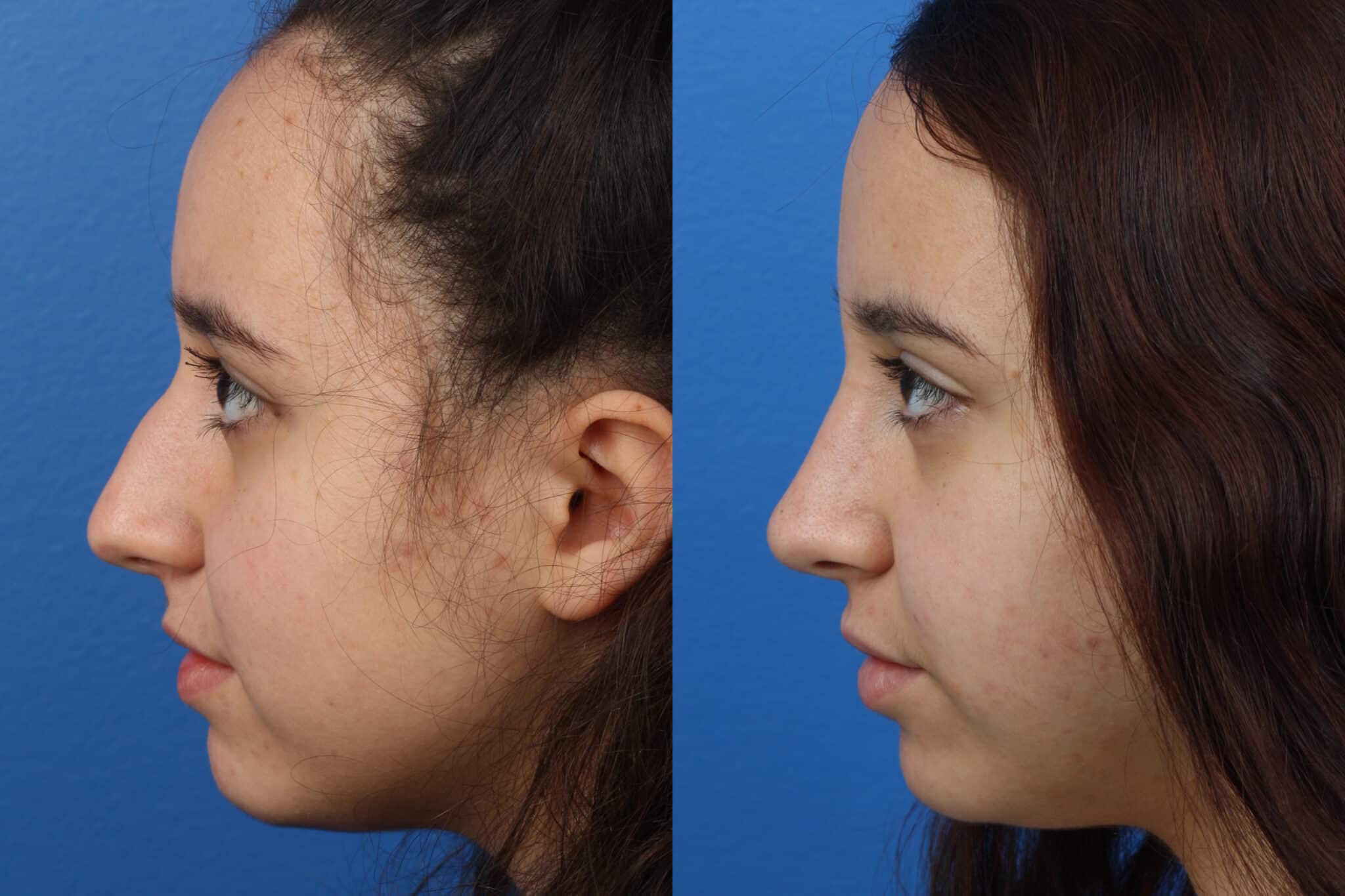 Rhinoplasty to straighten the nasal bridge of a female patient by Dr. Miller. After surgery, dorsal hump is gone and patient's profile is improved.