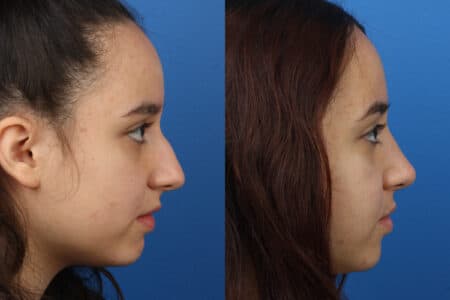 Rhinoplasty to Straighten the Nasal Bridge of a Female Patient by Dr. Miller