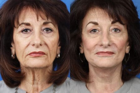 Facelift, Neck Lift, Dermabrasion and Earlobe Repair to Enhance the Appearance of a Female Patient by Dr. Miller.