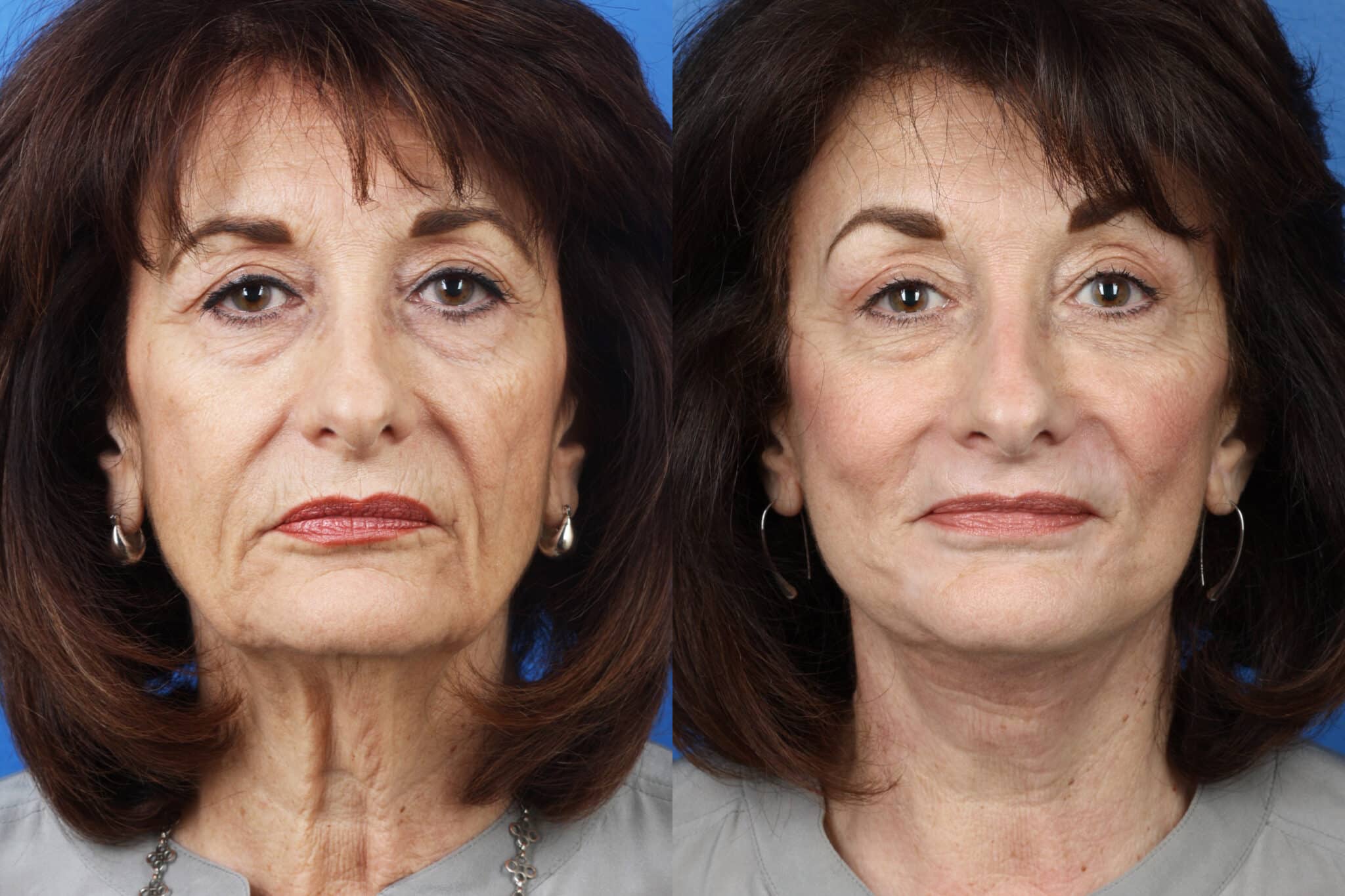 Facelift, neck lift, dermabrasion and earlobe repair to enhance the appearance of a female patient by Dr. Miller. Treatments tighten skin, reduce wrinkles, eliminate jowls, and address drooping earlobes.