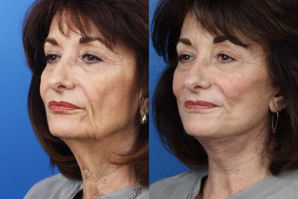 Facelift, neck lift, dermabrasion and earlobe repair to enhance the appearance of a female patient by Dr. Miller. Surgery and treatment reduces jowl formation and wrinkles while firming and smoothing skin.