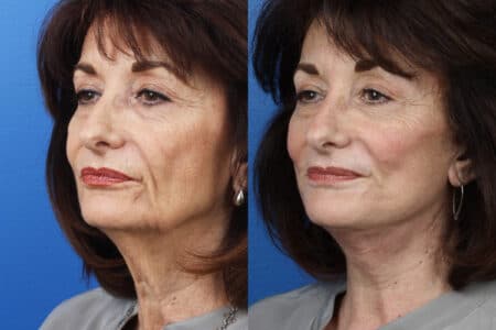 Facelift, Neck Lift, and Dermabrasion to Enhance the Appearance of a Female Patient by Dr. Miller.