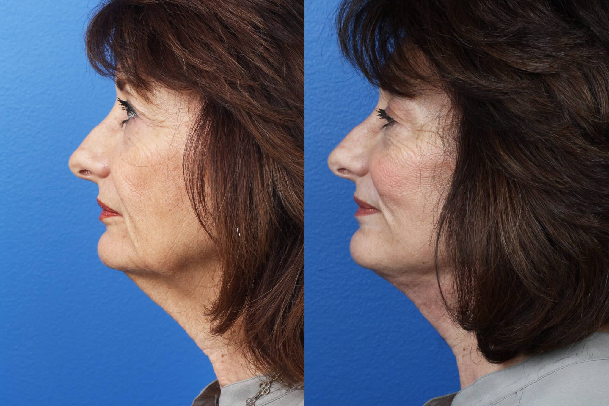 Facelift, neck lift, and dermabrasion to enhance the appearance of a female patient by Dr. Miller. Surgery removes loose skin, jowls, and wrinkles to produce a smoother, firmer facial profile.