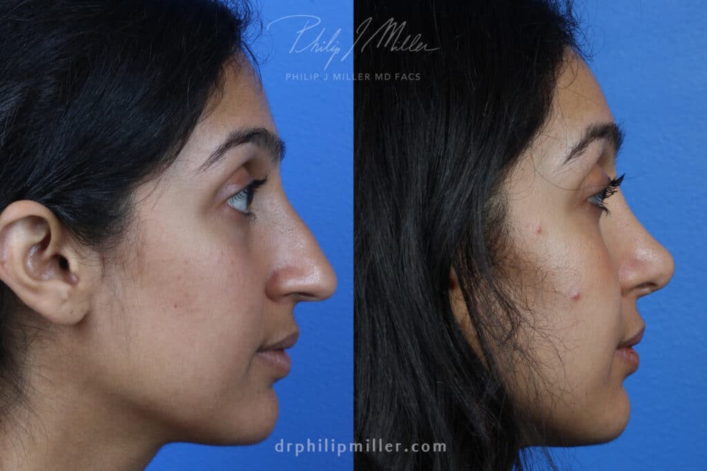 Rhinoplasty to correct the nasal bridge and tip of a female patient by Dr. Miller. After surgery, patient's nose has a more feminine slope and