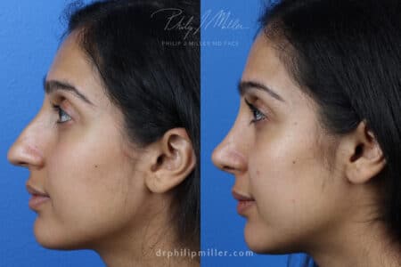 Rhinoplasty to Correct Nasal Bridge and Tip of a Female Patient by Dr. Miller