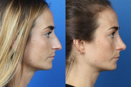 Rhinoplasty to Correct Nasal Bridge and Tip of a Female Patient by Dr. Miller